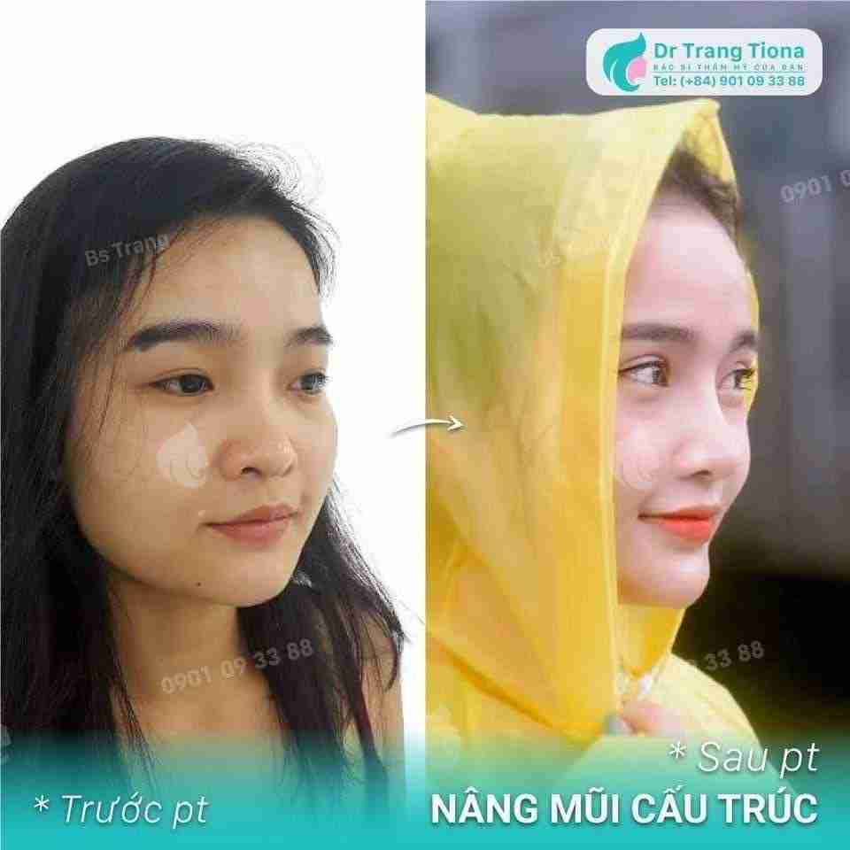 Bác sĩ giải đáp: Nâng mũi có vĩnh viễn không?