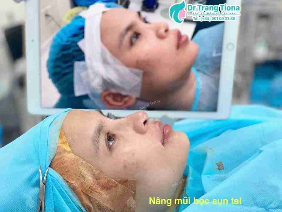 Bác sĩ giải đáp: Nâng mũi có vĩnh viễn không?