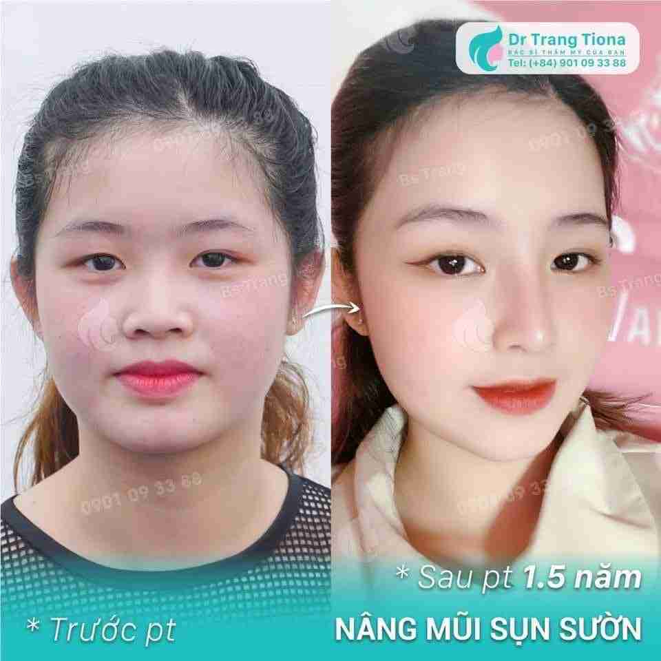 Bác sĩ giải đáp: Nâng mũi có vĩnh viễn không?
