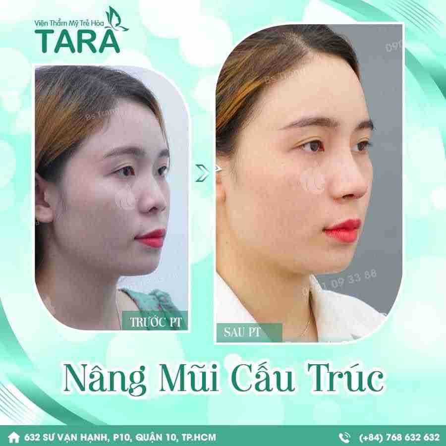 Bác sĩ giải đáp: Nâng mũi kiêng nằm nghiêng bao lâu?