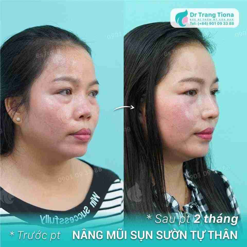 Bác sĩ giải đáp: Sửa mũi bao lâu thì đẹp tự nhiên?