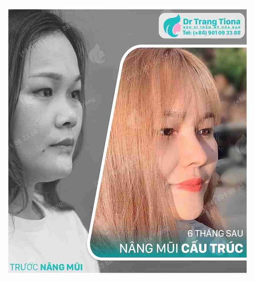 Bác sĩ giải đáp: Sửa mũi bao lâu thì đẹp tự nhiên?