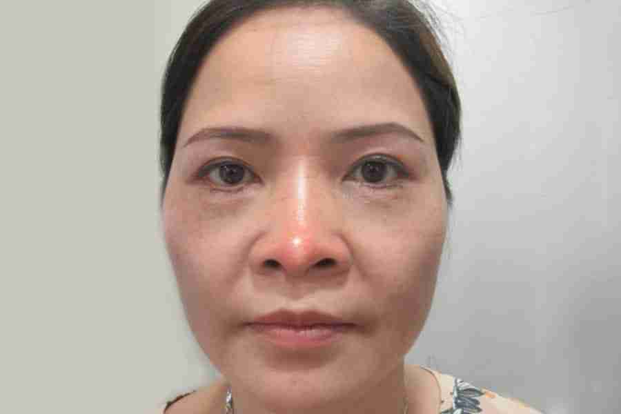 Bác sĩ Trang giải đáp: Mũi bị xơ cứng và cách điều trị