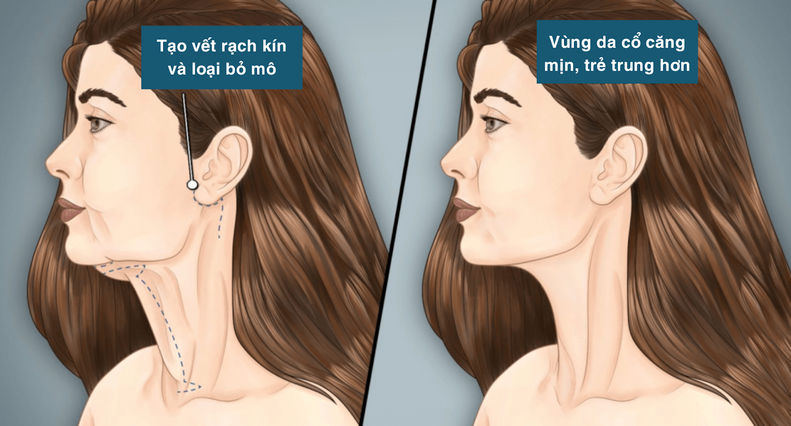 Bạn biết gì về 5 phương pháp trẻ hóa cổ hiện nay?