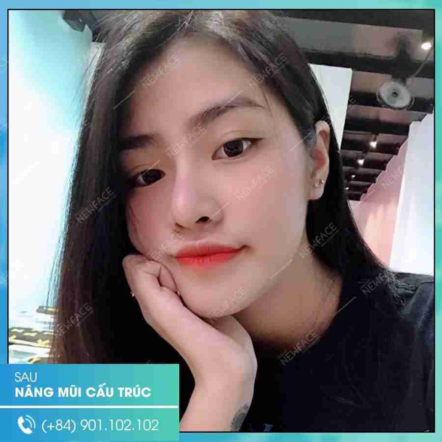 Bật mí 7 bí quyết để nâng mũi cấu trúc Surgiform đẹp
