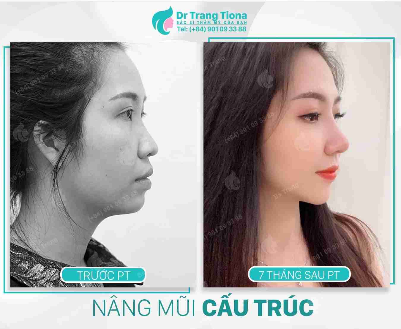 Cảnh báo: Các bệnh không được nâng mũi bạn cần biết