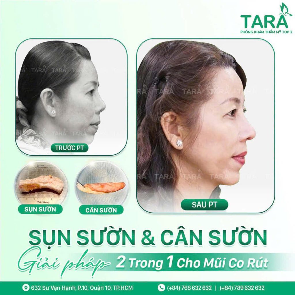Tiêu chí chọn bác sĩ & địa chỉ sửa lại mũi hỏng uy tín?