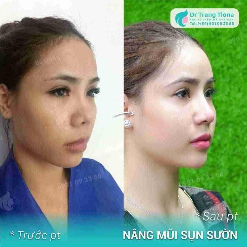 4 cách nâng mũi tại nhà đơn giản nhưng hiệu quả