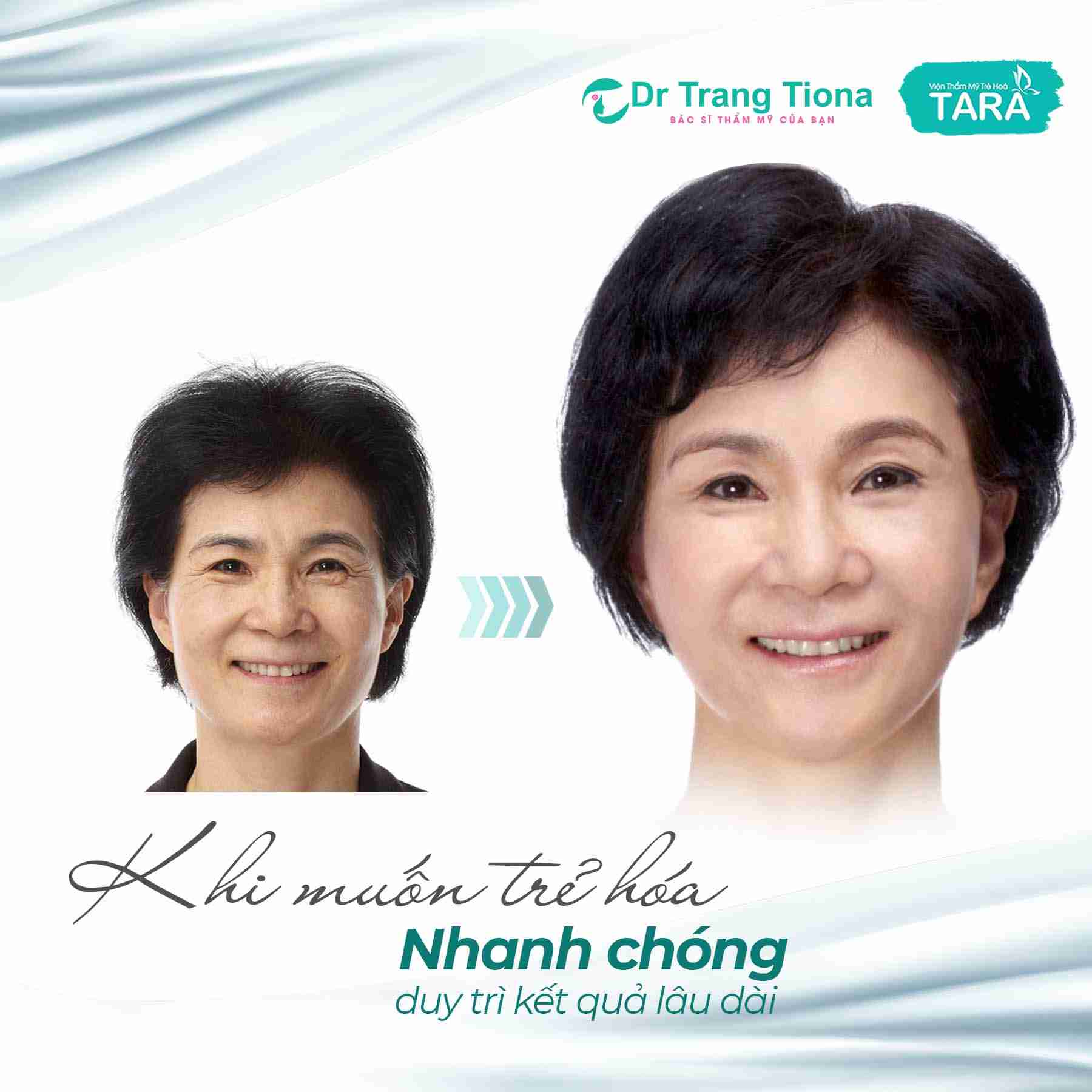 Phẫu thuật căng da mặt Midface bao lâu thì đẹp tự nhiên?