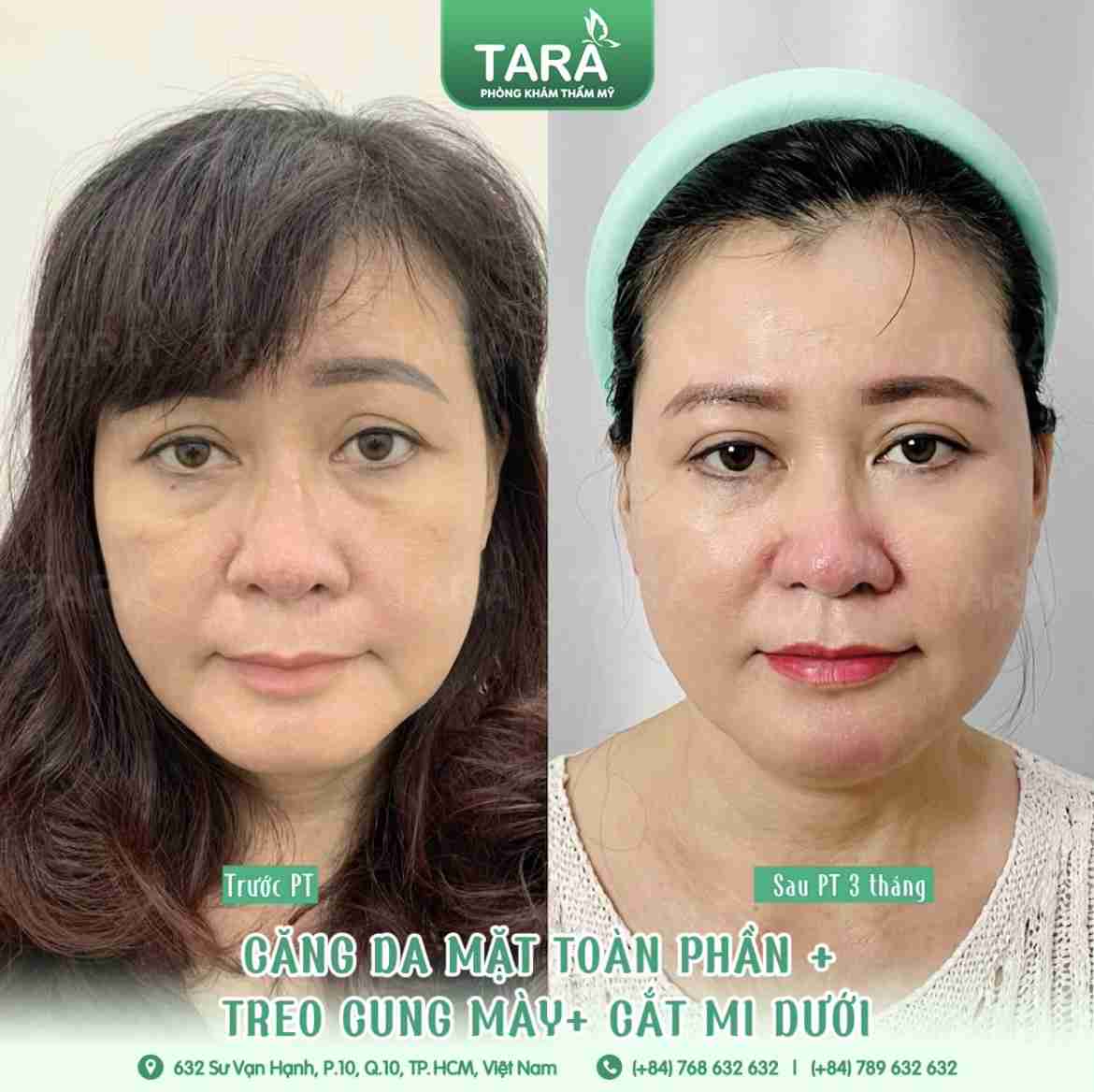 Căng da mặt toàn phần ở đâu thì tốt và  tiêu chí lựa chọn
