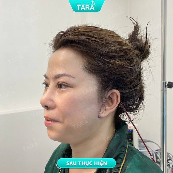 Căng da mặt toàn phần: trẻ hoá tự nhiên, không để lại sẹo