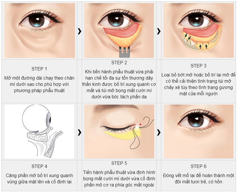 Căng da Midface có giúp làm đầy hốc mắt không?