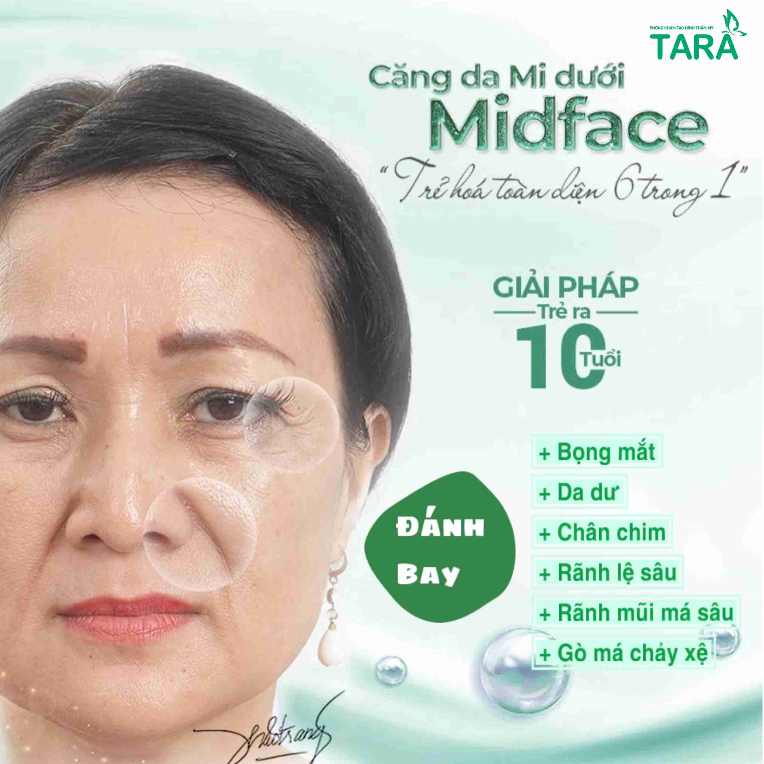Căng da Midface hồi phục trong bao lâu?