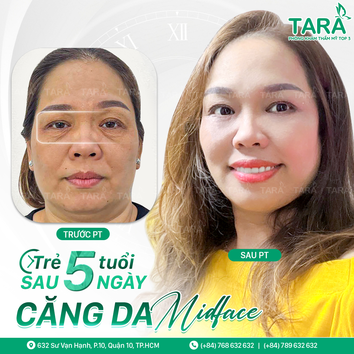 Căng da Midface mi dưới có nguy hiểm thị lực không?