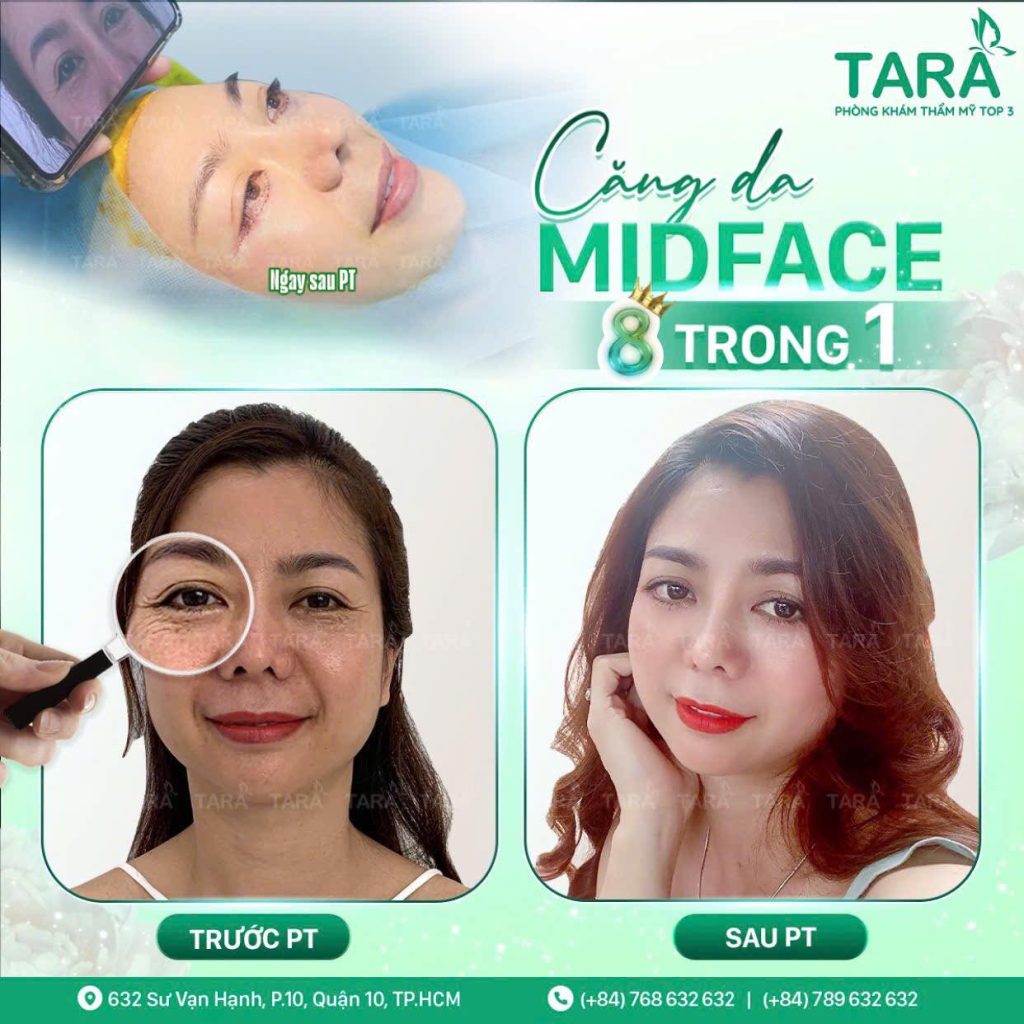Căng da MIDFACE – Phẫu thuật trẻ hoá tầng mặt giữa ít xâm lấn hiệu qủa nhất hiện nay