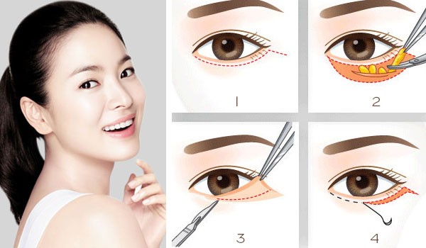 Vì sao căng da Midface là “liệu pháp trẻ hóa tầng giữa mặt 8 trong 1”?