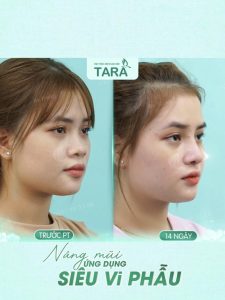 Căng da Midface xong có nâng mũi ngay được không?