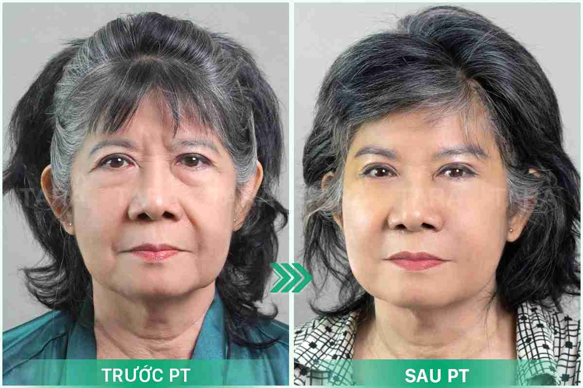Phẫu thuật căng da thái dương bao lâu thì đẹp tự nhiên?