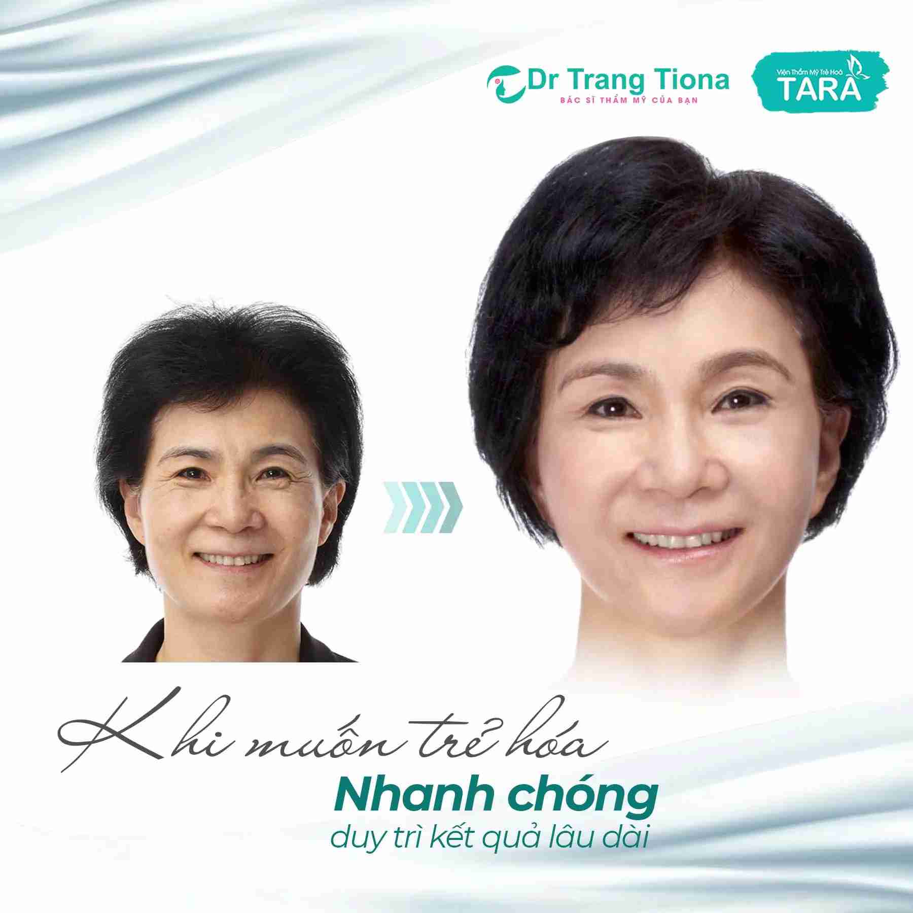 Phẫu thuật căng da thái dương bao lâu thì đẹp tự nhiên?