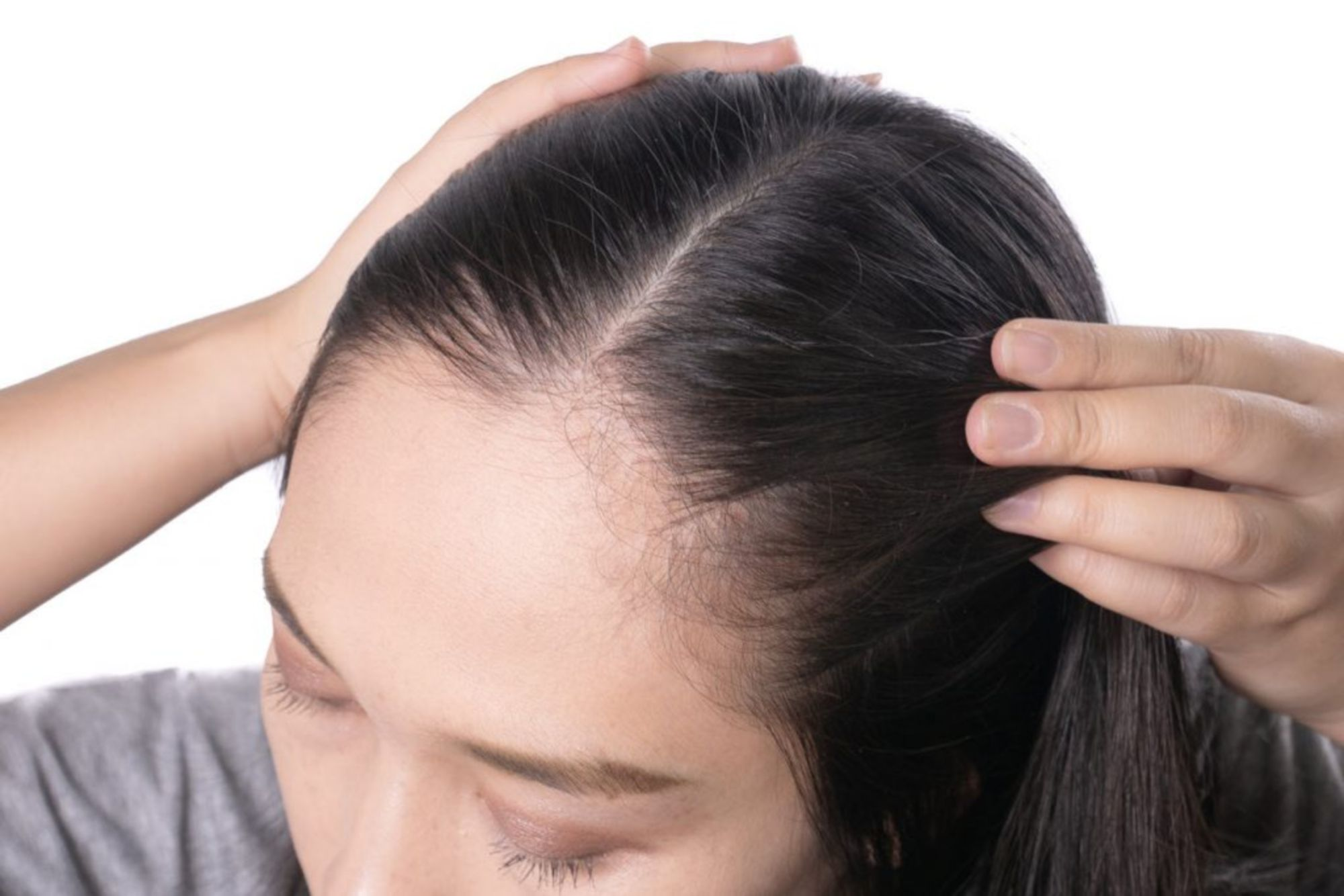 Căng da thái dương có ảnh hưởng gì không?