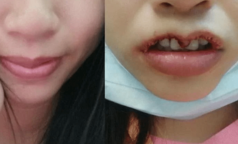 Cảnh báo biến chứng nguy hiểm cắt môi trái tim