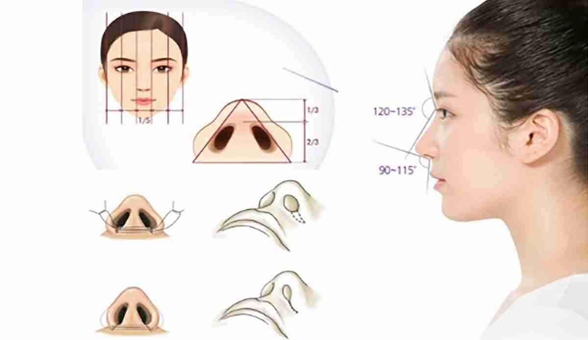 Bác sĩ giải đáp: Cắt cánh mũi có làm mũi cao lên không?