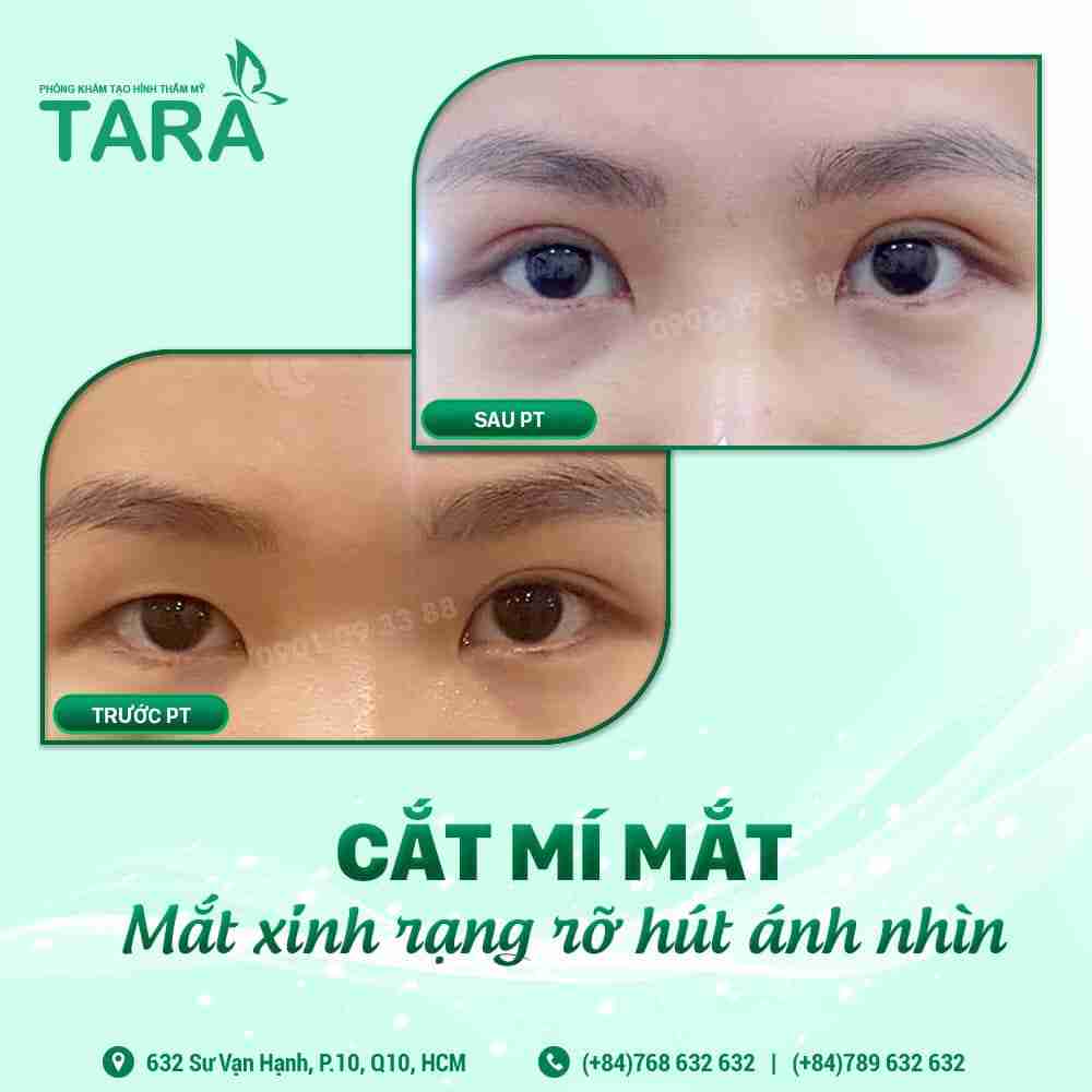 Cắt mí giá bao nhiêu? 5 triệu có đủ để cắt mí không?