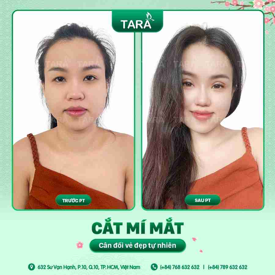 Cắt mí hay nhấn mí? Đâu là lựa chọn tối ưu?