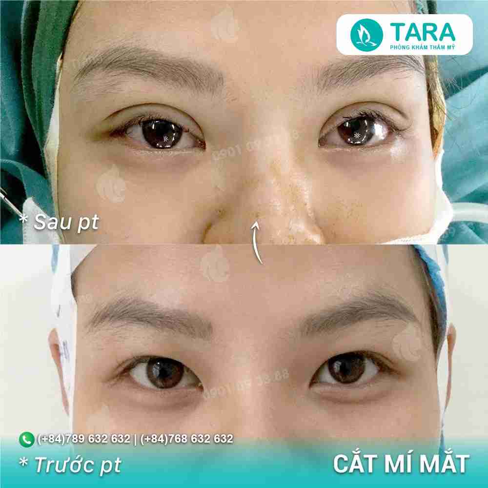 Cắt mí mắt bao lâu thì được trang điểm?