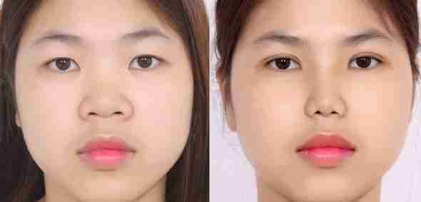 Cắt mí mắt bao lâu thì nhìn tự nhiên nhất?