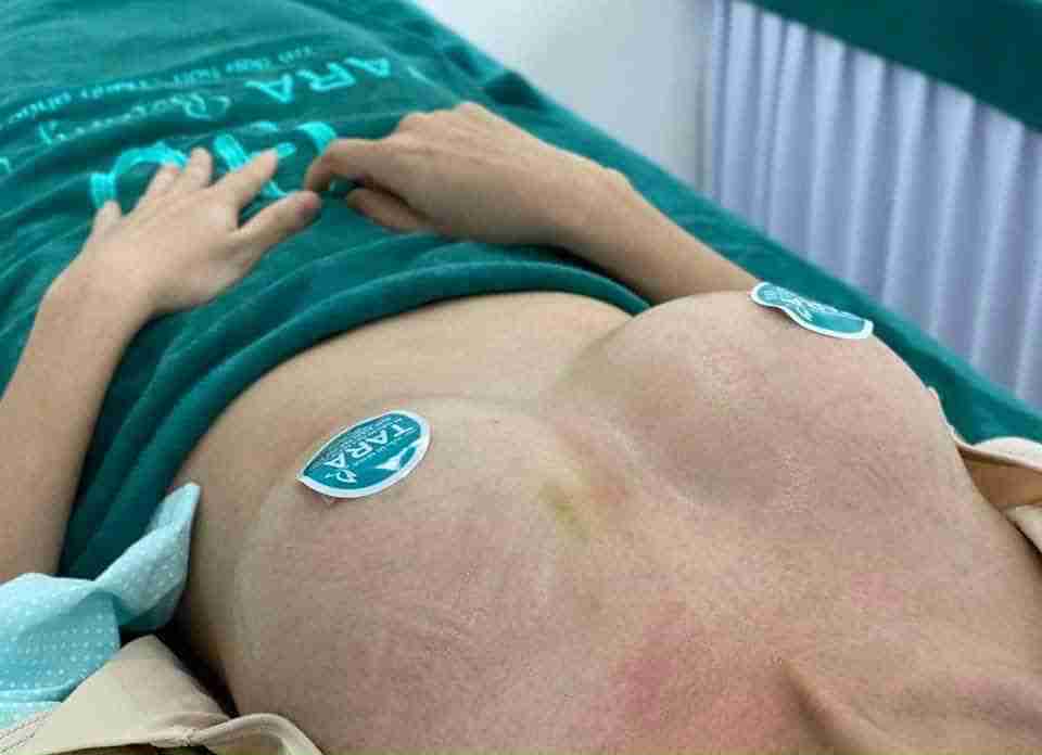 7 câu hỏi thường gặp trước khi phẫu thuật nâng ngực