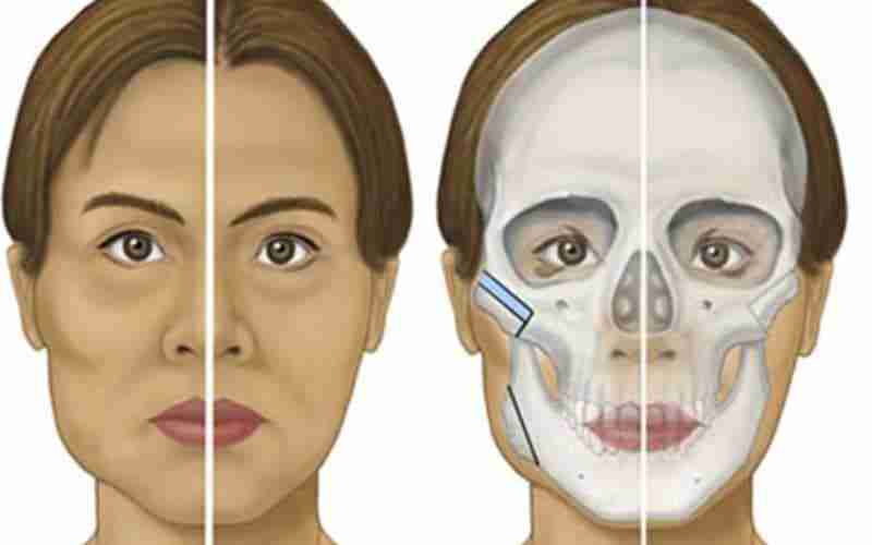 Cấy mỡ má hóp – Nhân tố mới giúp trẻ hóa vượt trội