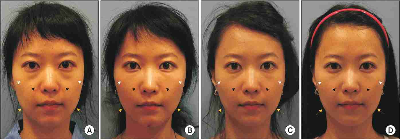 Cấy mỡ mặt Baby Face được thực hiện như thế nào?