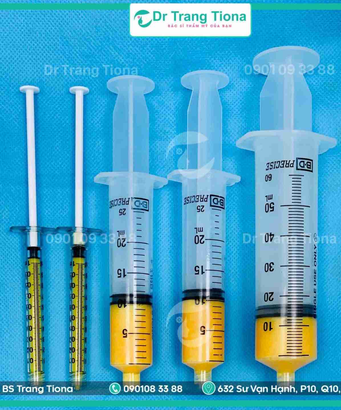 Cấy mỡ mặt giá bao nhiêu, cần lưu ý gì khi thực hiện?