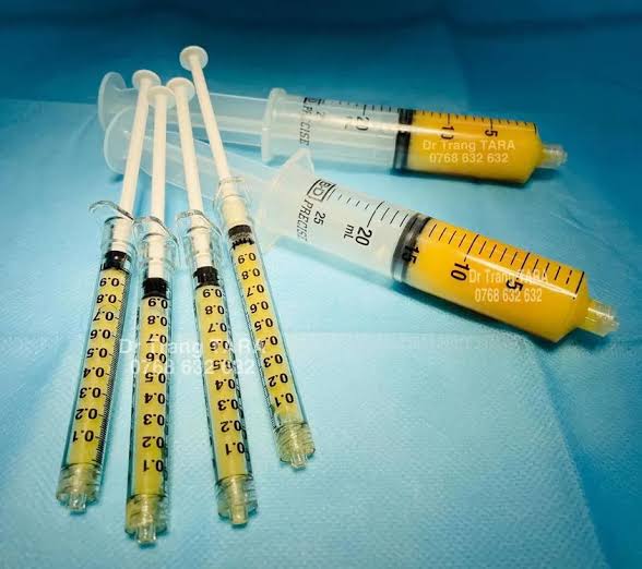 Cấy Mỡ Tạo Hình Khuôn Mặt 4T2N – Giải Pháp Lấy Lại Thanh Xuân Rực Rỡ