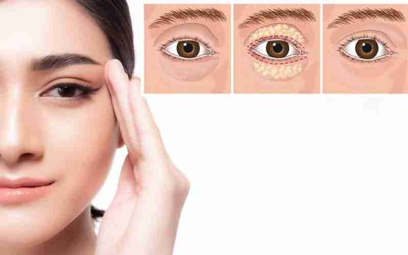 Toàn bộ thông tin về cấy mỡ tự thân hốc mắt trẻ hóa mắt