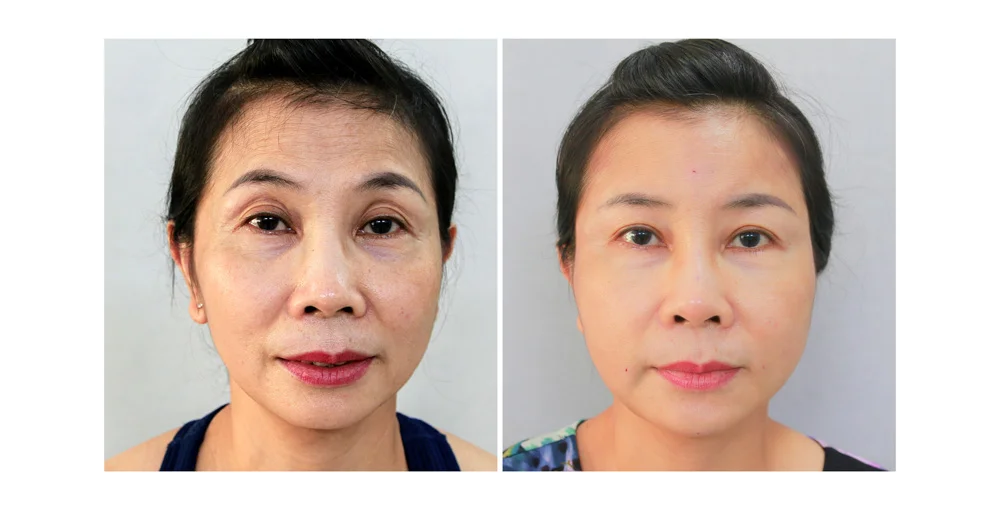 Toàn bộ thông tin về cấy mỡ tự thân hốc mắt trẻ hóa mắt