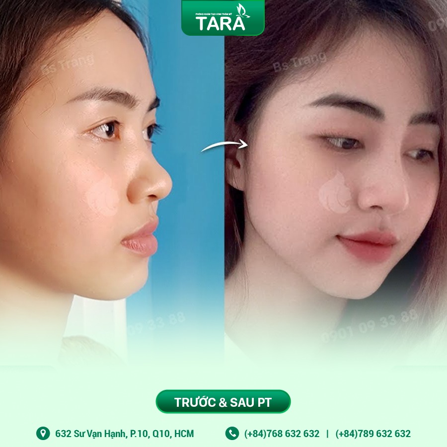 Chi phí nâng mũi siêu vi phẫu tại Bác sĩ Trang – Tara Clinic