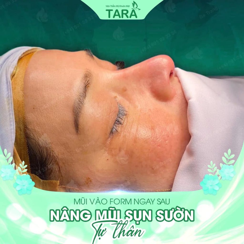Chi phí nâng mũi siêu vi phẫu tại Bác sĩ Trang – Tara Clinic