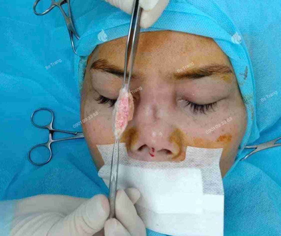 Chi phí nâng mũi trung bì mỡ ở TPHCM giá bao nhiêu?