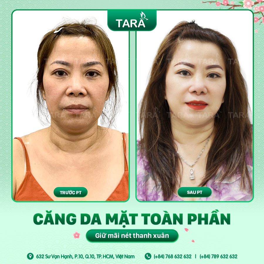 Chi phí phẫu thuật căng da mặt toàn phần 2025