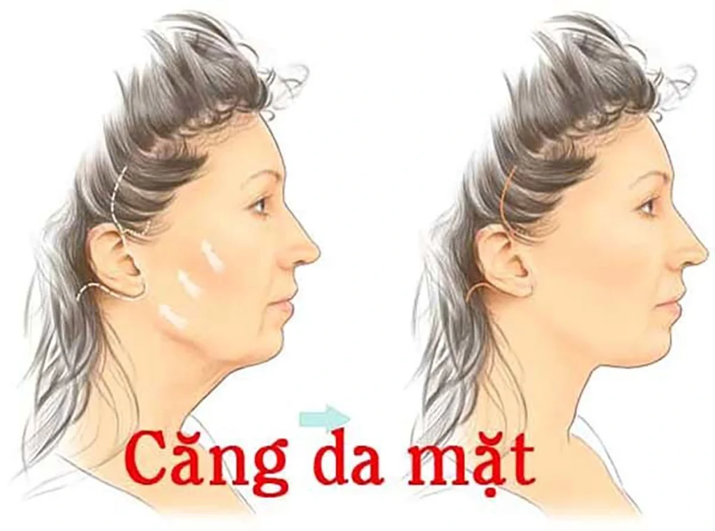 Chi phí phẫu thuật căng da mặt toàn phần 2025