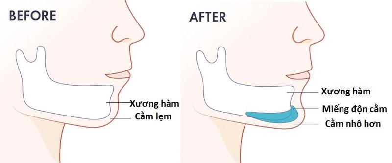 Có nên độn cằm không? Hiệu quả như thế nào?