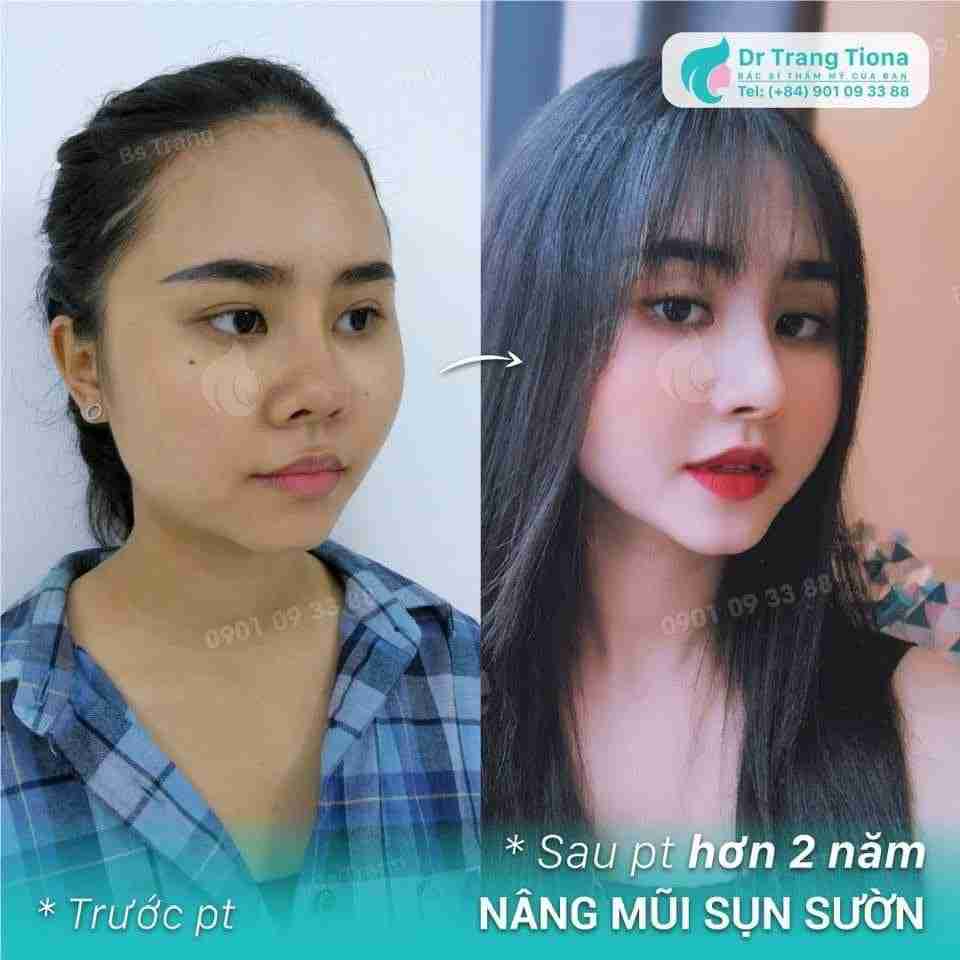 Có nên nâng mũi không?