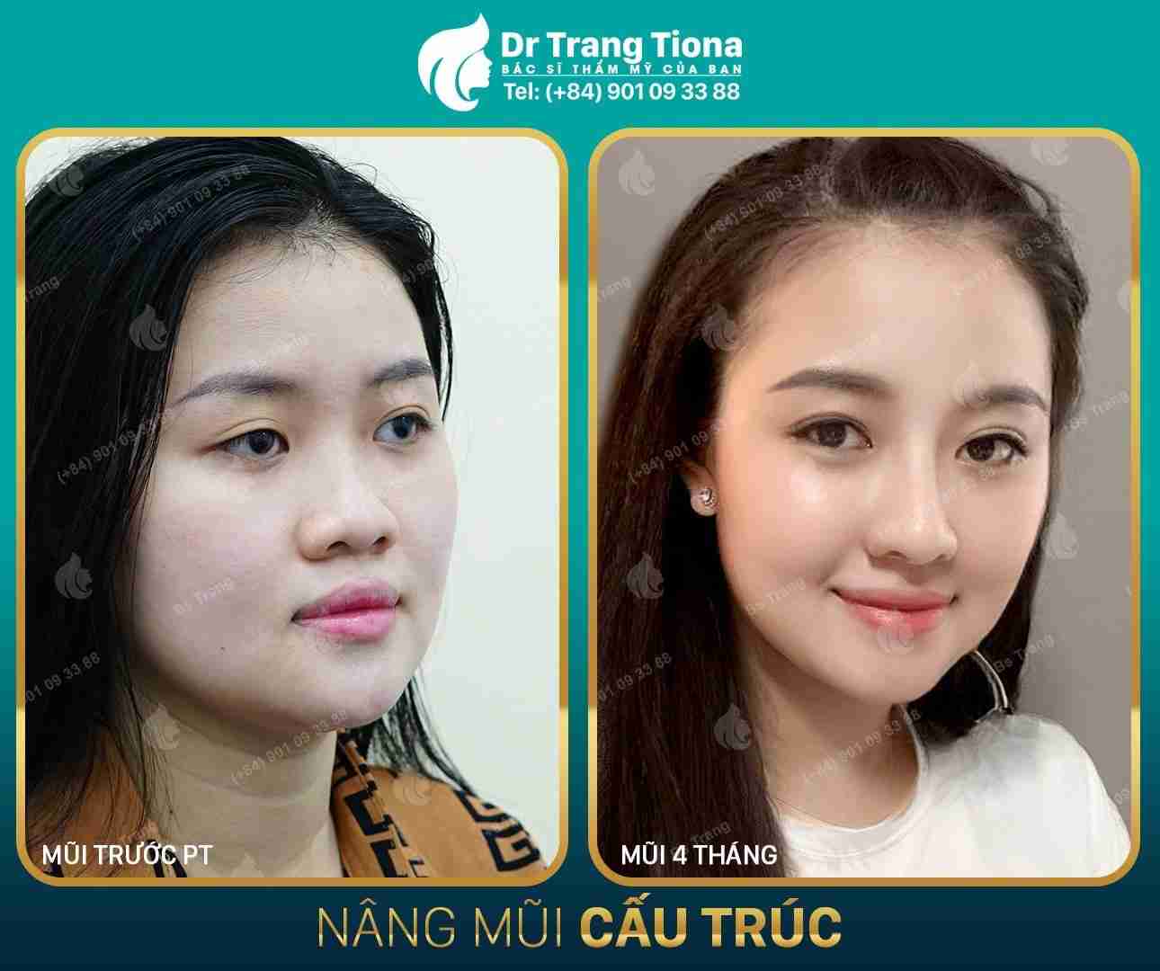 Có nên nâng mũi không?