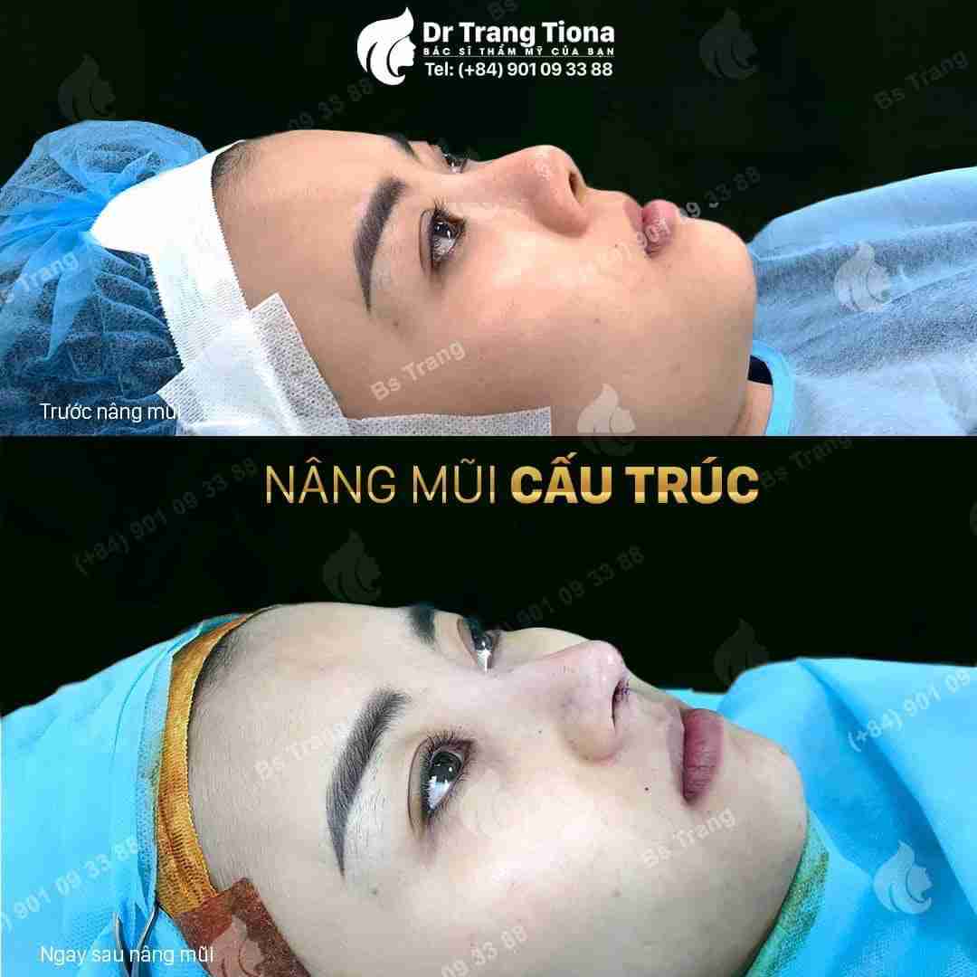 Có nên nâng mũi Sline Hàn Quốc không?