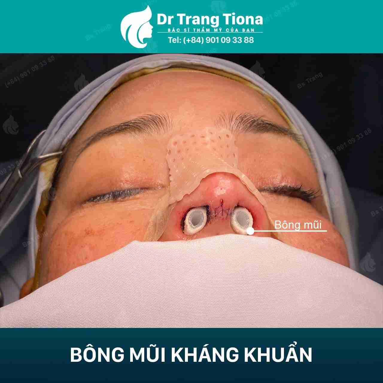 Có nên vận động nhiều sau nâng mũi? Tại sao?