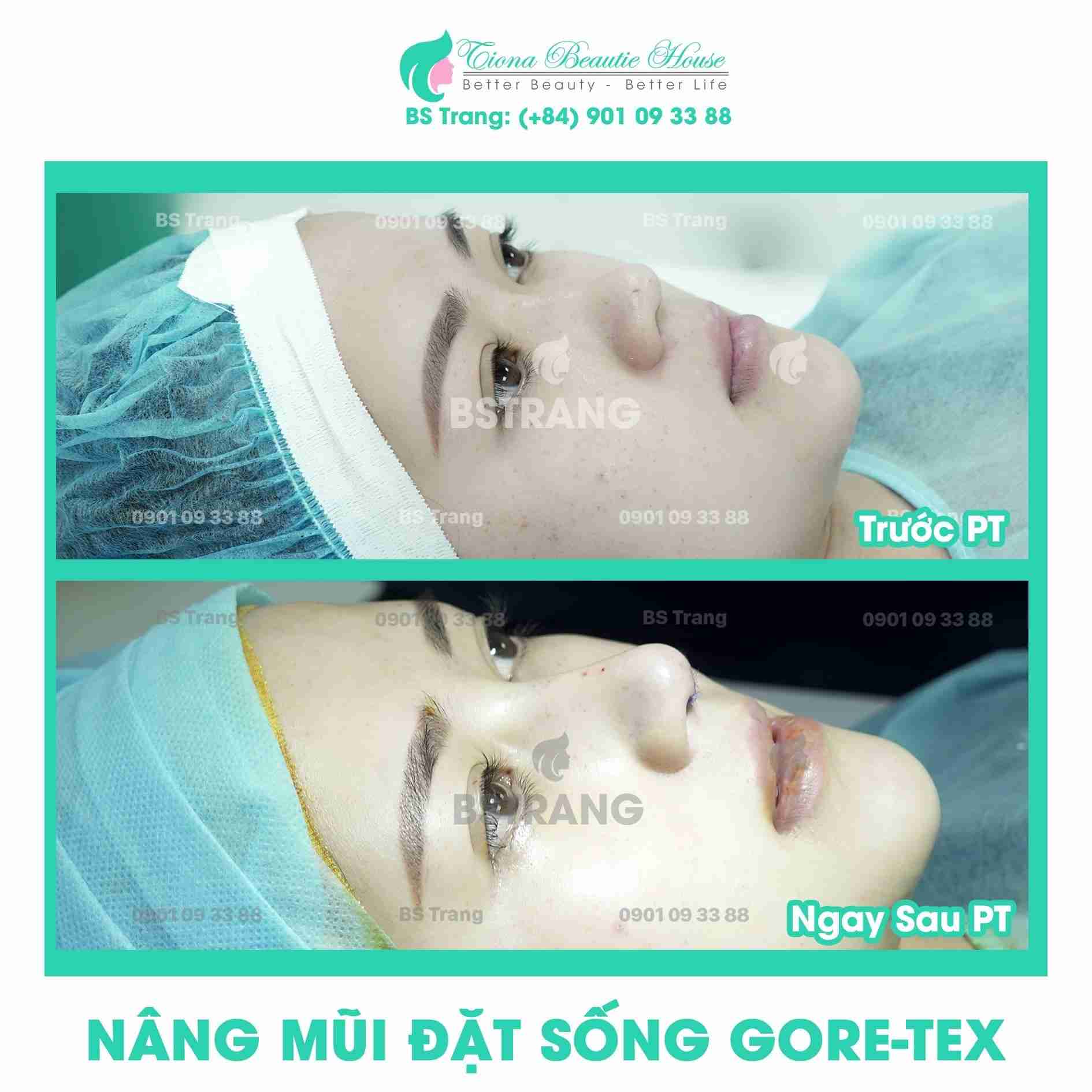 Có nên vận động nhiều sau nâng mũi? Tại sao?