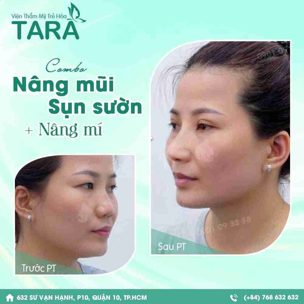 Có nên vừa nâng mũi, vừa cắt mí không?
