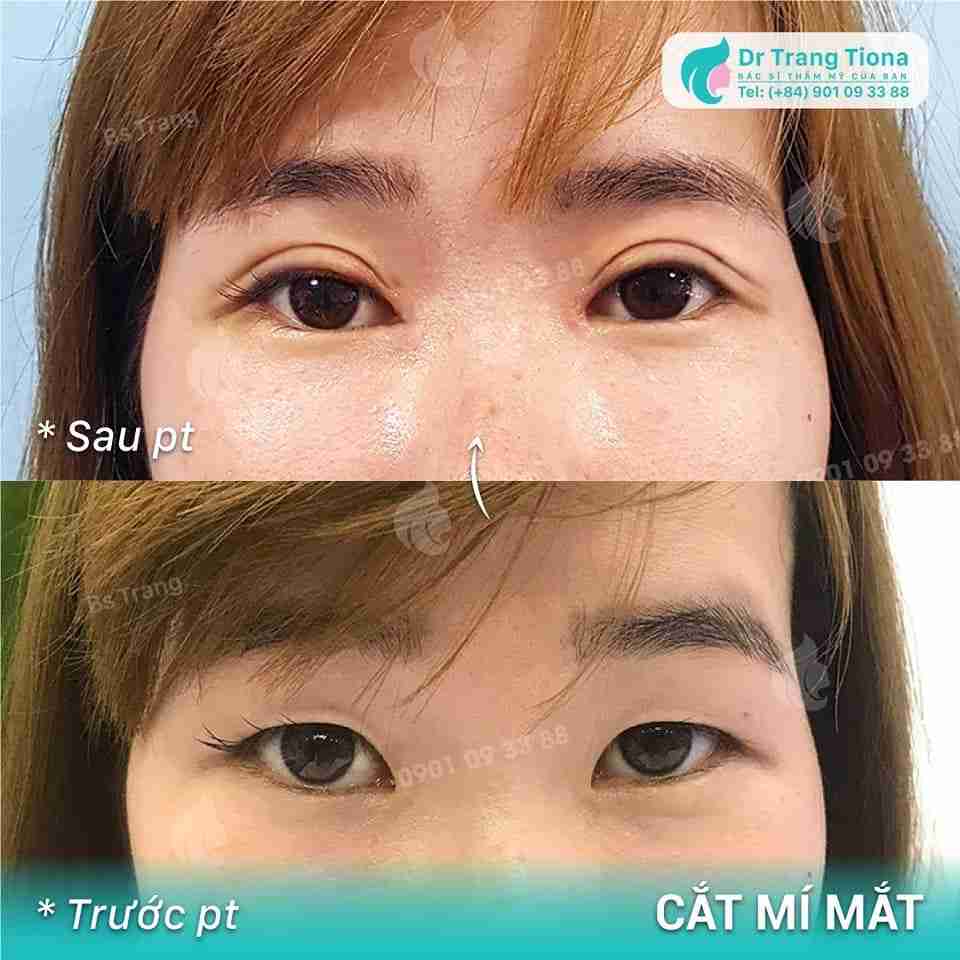 Có nên vừa nâng mũi, vừa cắt mí không?